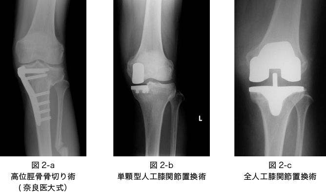 当科での変形性膝関節症に対する手術加療
